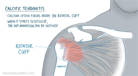 Rotator Cuff Tears and Shoulder Pain at Night