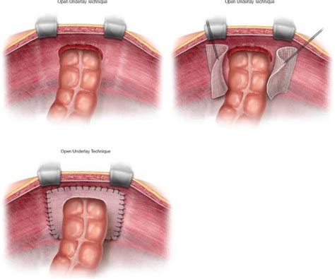 Parastomal Repair Open Techniques Abdominal Key