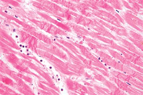 Myocardial infarction | pathology | Britannica