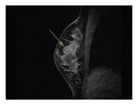 Mri Image Of Triple Negative Breast Cancer A Before Nac T W B