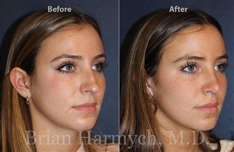 Good Rhinoplasty Before And After