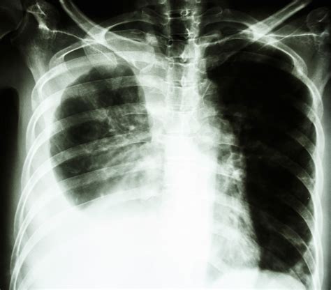 Healthy Lungs Vs Smokers Lungs X Ray