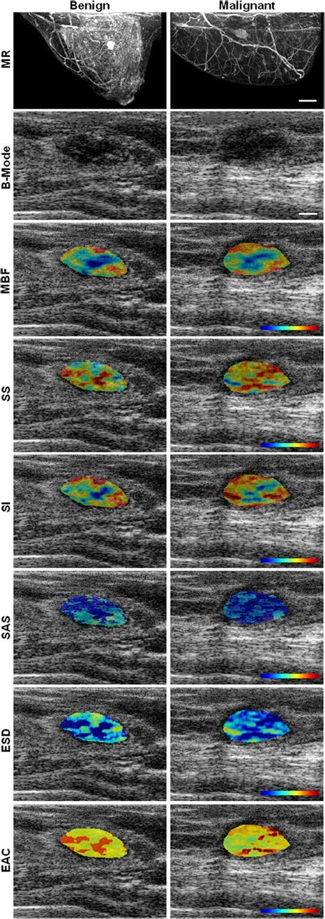 Breast Lesion Characterization Using Textural Features Of Quantitative