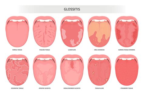 Gum Cancer Symptoms And Treatment Curaprox