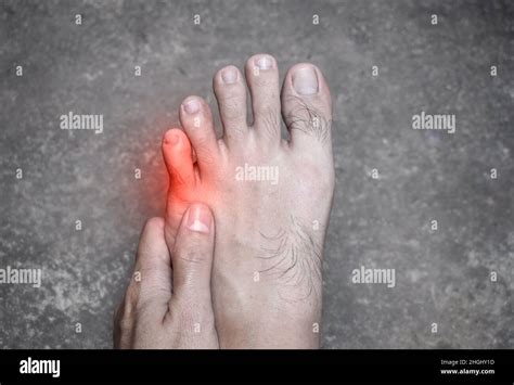 Bunions Feet Hi Res Stock Photography And Images Alamy