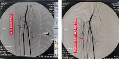 陕西省中医医院成功完成一例下肢血管成型术 陕西省中医药研究院陕西省中医医院