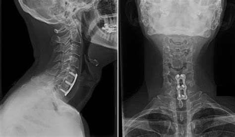 Anterior Cervical Spinal Fusion Surgery