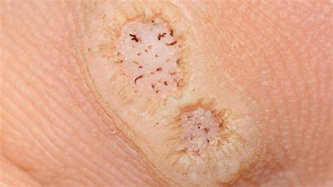 Plantar Wart Treatment At Home 6 Effective Approaches First For Women