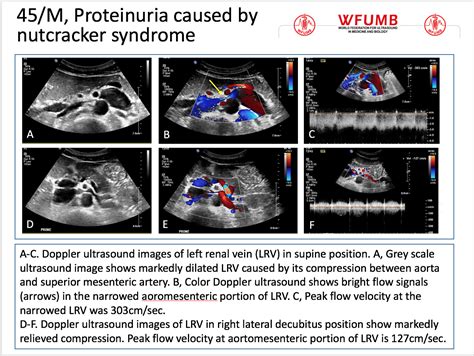 Nutcracker Syndrome Ultrasound