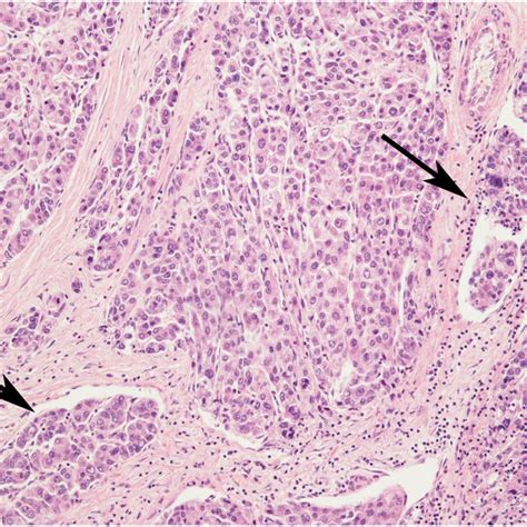 An Example Of Histologically Advanced Hepatocellular Carcinoma Download Scientific Diagram