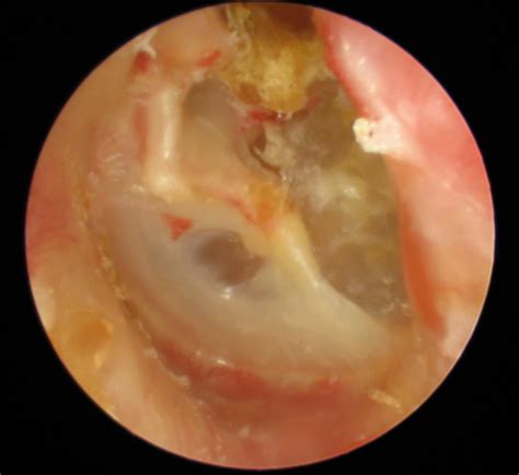 Chronic Suppurative Otitis Media With Cholesteatoma