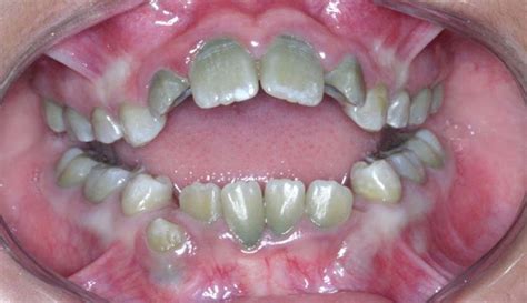 Green Teeth In The Primary And Permanent Dentition The Journal Of