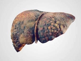 Health Risks Of Chronic Heavy Drinking Liver Disease Pancreatitis