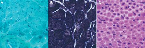 Congenital Muscular Dystrophy and Congenital Myopathy : CONTINUUM ...