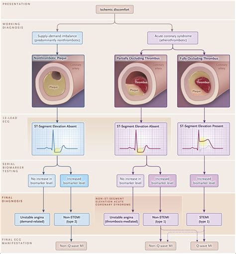 Acute Myocardial Infarction Nejm