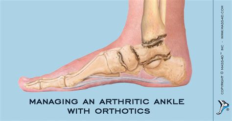 Treating An Arthritic Ankle With Orthotics Mass4d® Foot Orthotics