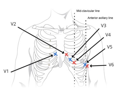 Ekg Interpretation Flashcards Quizlet