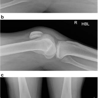 A Lateral Radiograph Of The Left Knee Demonstrating A Patella Alta