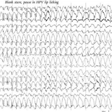 Ictal Eeg Recording Of Patient With Jme With Myoclonic Jerks