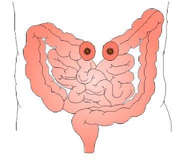 Med Surg Chapters Upper Lower Gastrointestinal Problems Aki