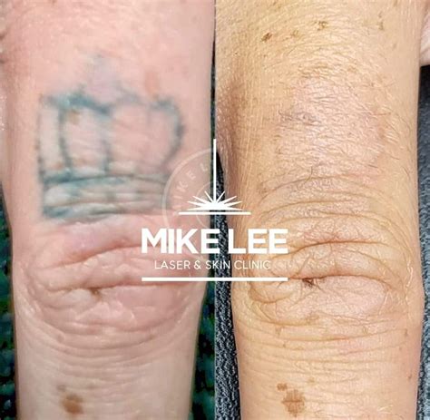 Body Clinic Tattoos Laser Tattoo Removal | Emma J Aesthetics