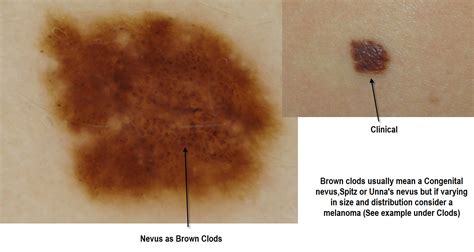 Dermoscopy Made Simple Benign Nevus