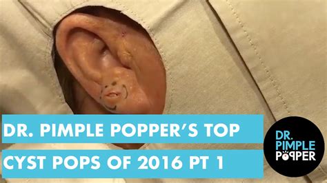 Dr Pimple Poppers Top 10 Cyst Pops Of 2017 Part 1 Dr Pimple Popper