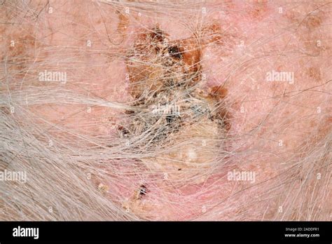 Squamous Cell Carcinoma On The Scalp Of A 90 Year Old Man This Form Of