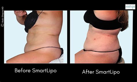 Smartlipo® And Traditional Lipo The Difference The Womens Journal