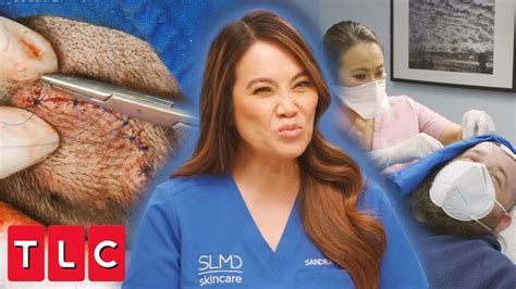 Dr Lee Pops Out Six Scalp Cysts Dr Pimple Popper Youtube