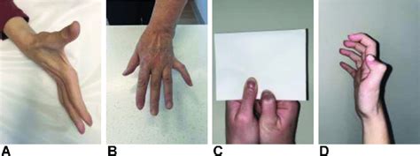 Physical Examination Findings And Signs In Patients With Cuts A Ulnar