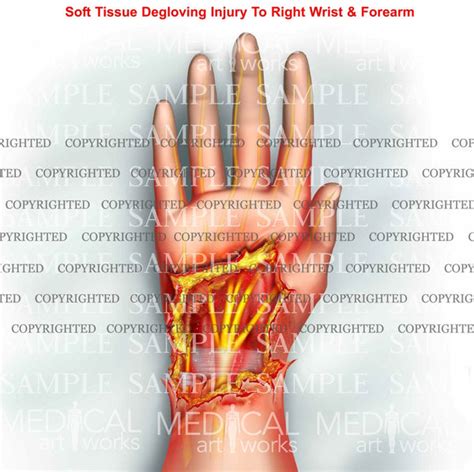 Right hand degloving injury — Medical Art Works