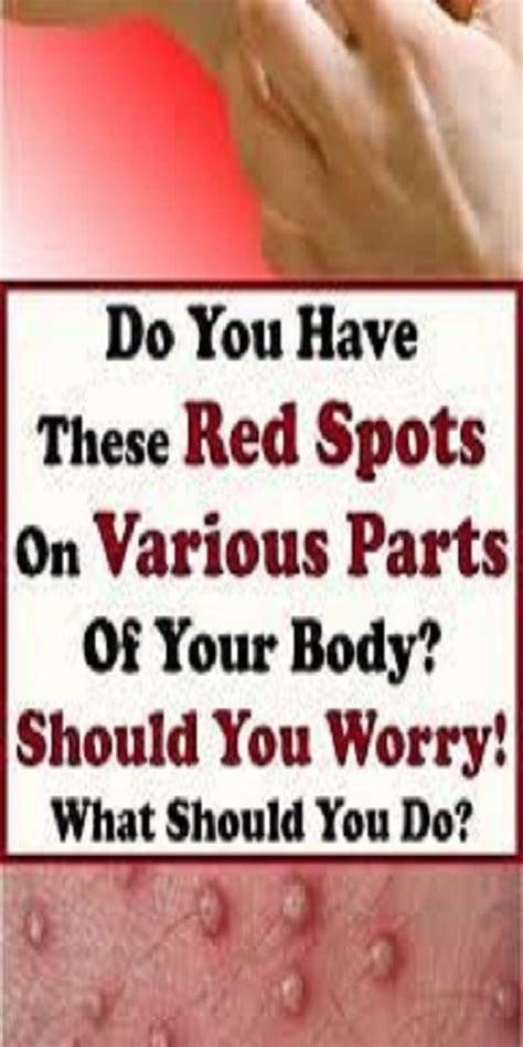 Do You Have These Red Spots On Various Parts Of Your Body Should You