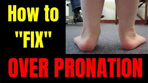 How To Really Fix Overpronation Flat Feet And Collapsed Arches Truth