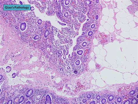 Qiao S Pathology Angiodysplasia Of The Colon A Photo On Flickriver