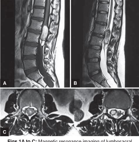 Figure 1 From A Rare Case Of Intramedullary Dermoid With Atypical