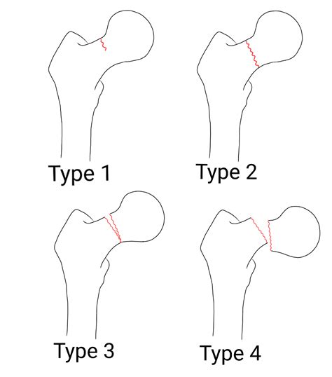 Femoral Neck Fracture Classification