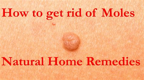 How To Get Rid Of Moles Natural Home Remedies Youtube