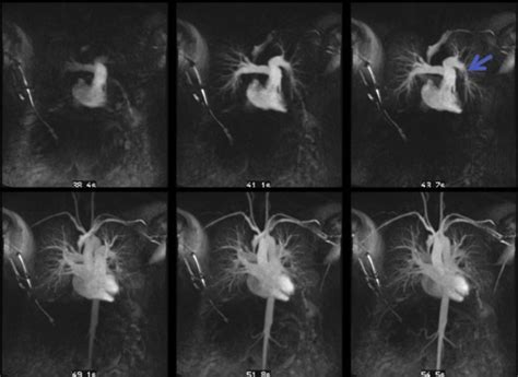 Pulmonary Vascular Disease Evaluation With Magnetic Resonance