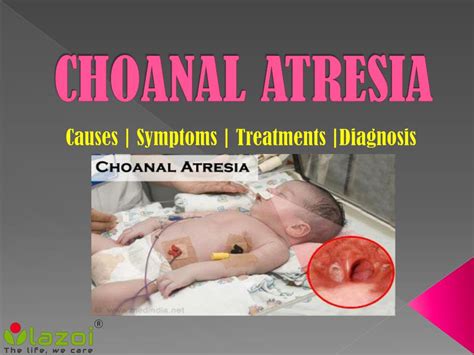 Ppt Choanal Atresia Symptoms Causes Treatment And Prevention