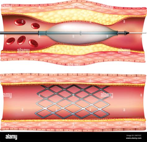 Angioplastie de stent coronaire Banque de photographies et dimages à