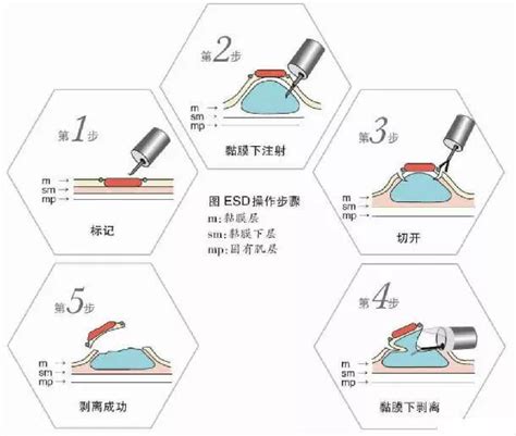 不开刀也能切早癌——内镜黏膜下剥离术esd 黏膜下剥离术 Esd 消化道 内镜 健康界