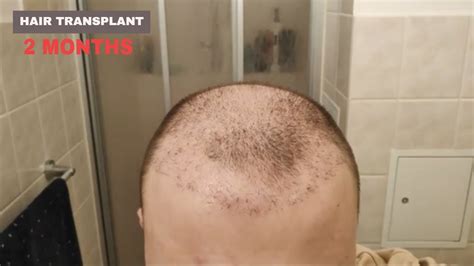 Hair Transplant Results 2 Months YouTube