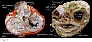 Atlas Cardiac Anatomy For Electrophysiologist