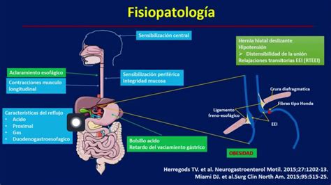 Enfermedad Por Reflujo Gastroesofágico Youtube