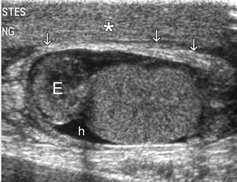 Gray Scale And Color Doppler Sonography Of Scrotal Disorders In