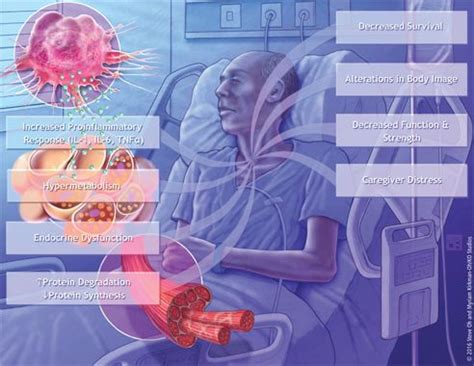 The Evolving Approach to Management of Cancer Cachexia