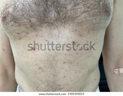 Multiple Erythematous Papule Chest Wall Abdominal Stock Photo