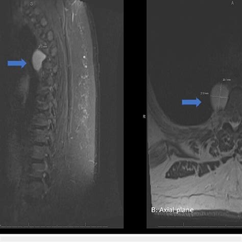 Mri Of The Thoracic Spine Mri Of The Thoracic Spine Showing The Cyst