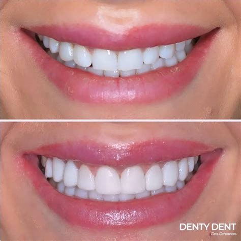 Tipos de Carillas Dentales Qué son las carillas Denty Dent